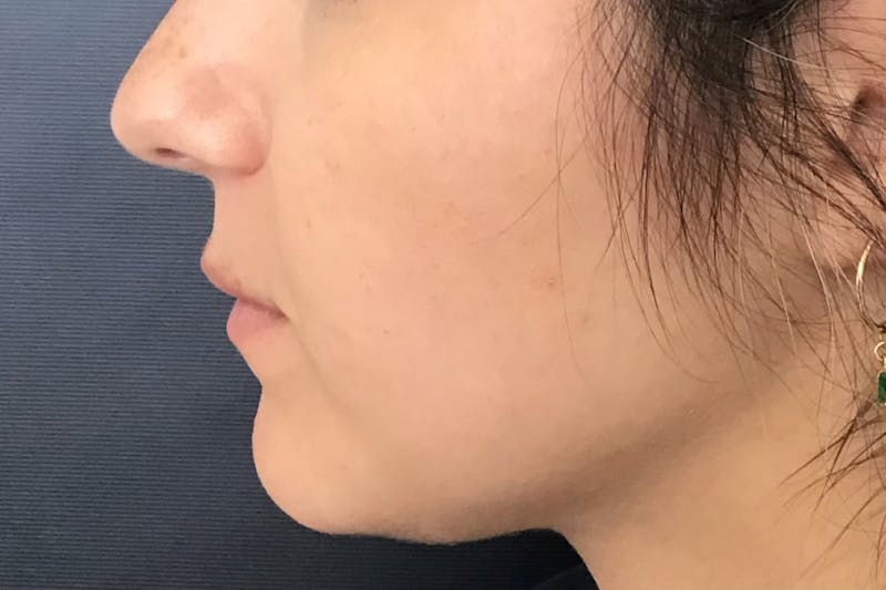 Dermal Fillers Before & After Gallery - Patient 237955 - Image 3