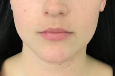 Dermal Fillers Before & After Gallery - Patient 154004 - Image 1