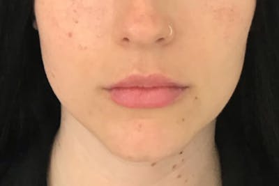 Dermal Fillers Before & After Gallery - Patient 154004 - Image 2