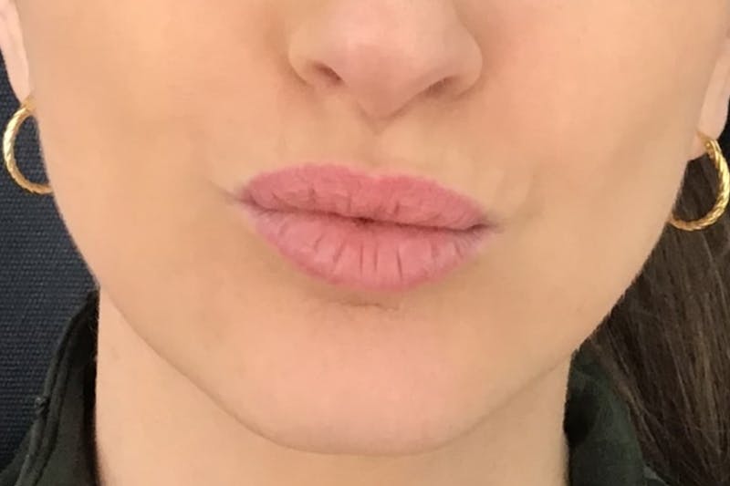 Dermal Fillers Before & After Gallery - Patient 240217 - Image 3