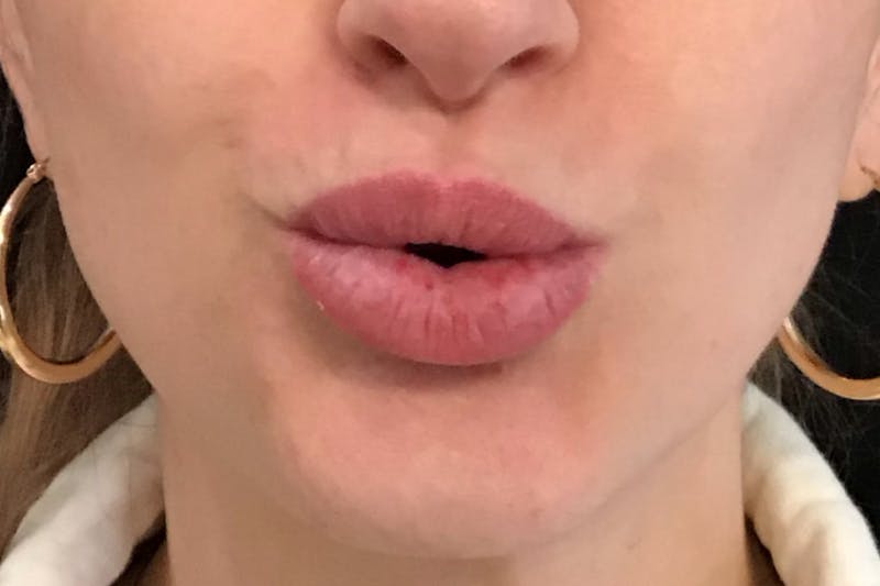 Dermal Fillers Before & After Gallery - Patient 240217 - Image 4