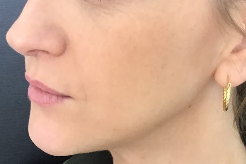 Dermal Fillers Before & After Gallery - Patient 240217 - Image 5