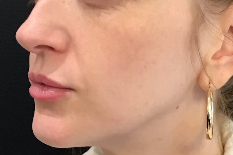 Dermal Fillers Before & After Gallery - Patient 240217 - Image 6