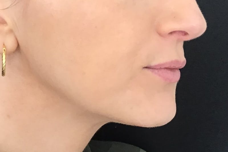 Dermal Fillers Before & After Gallery - Patient 240217 - Image 7