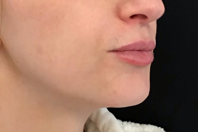 Dermal Fillers Before & After Gallery - Patient 240217 - Image 8