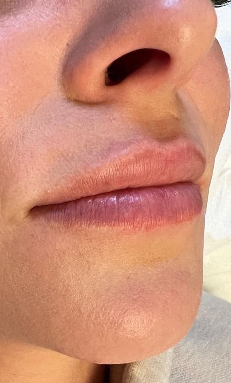 Dermal Fillers Before & After Gallery - Patient 321786 - Image 3