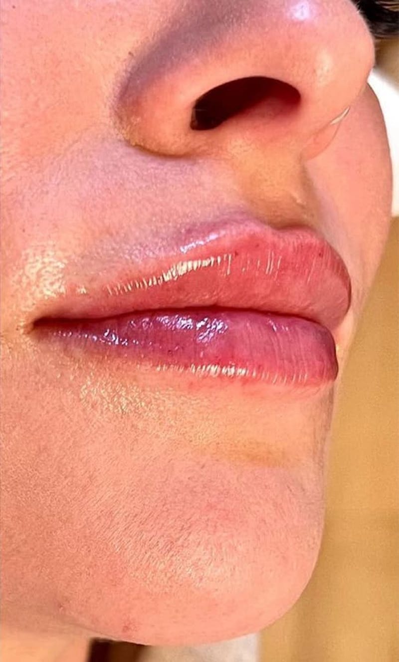 Dermal Fillers Before & After Gallery - Patient 321786 - Image 4