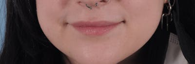 Dermal Fillers Before & After Gallery - Patient 958481 - Image 1