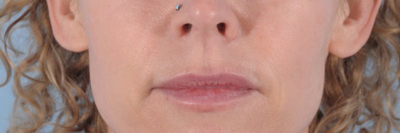 Dermal Fillers Before & After Gallery - Patient 273174 - Image 2