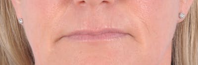 Dermal Fillers Before & After Gallery - Patient 129556 - Image 1