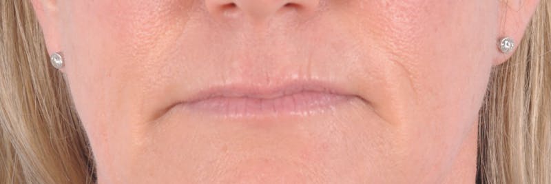 Dermal Fillers Before & After Gallery - Patient 129556 - Image 1