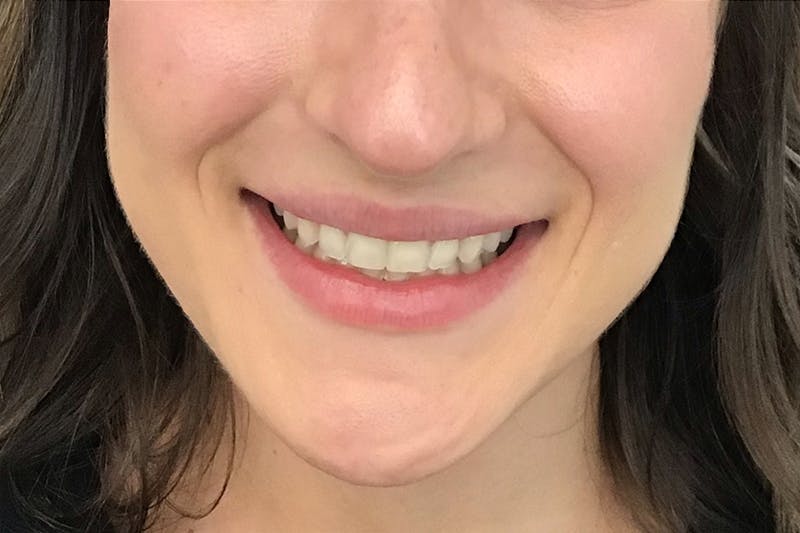 Dermal Fillers Before & After Gallery - Patient 290866 - Image 4