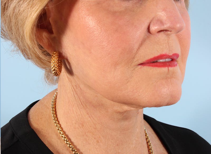 Neck Lift Before & After Gallery - Patient 208417 - Image 2