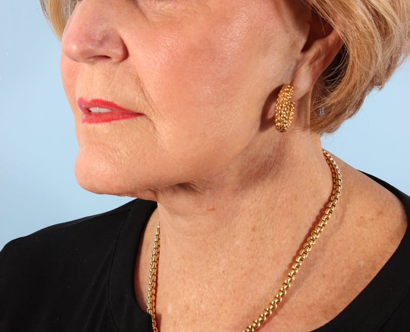 Fat Transfer Before & After Gallery - Patient 272233 - Image 6