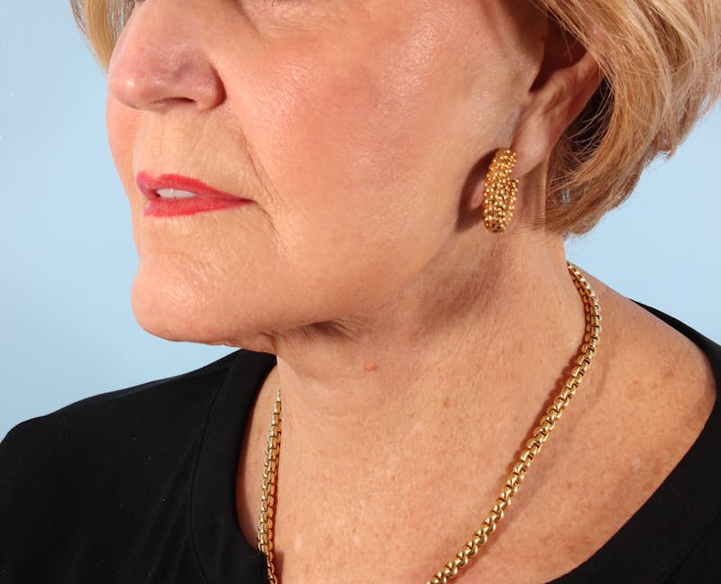 Facelift Before & After Gallery - Patient 238249 - Image 6