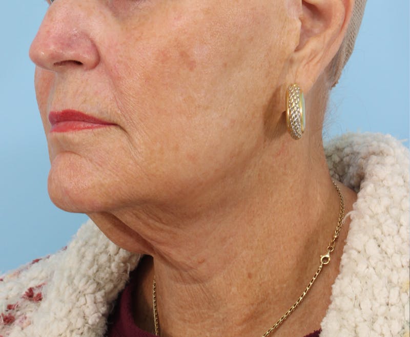 Neck Lift Before & After Gallery - Patient 208417 - Image 5