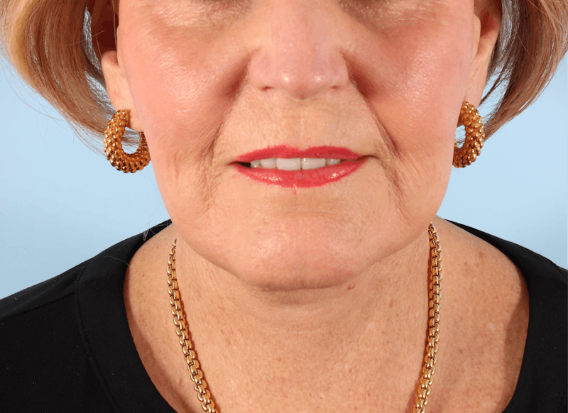 Facelift Before & After Gallery - Patient 238249 - Image 2