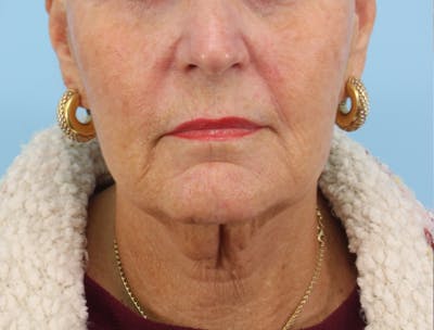 Facelift Before & After Gallery - Patient 238249 - Image 1