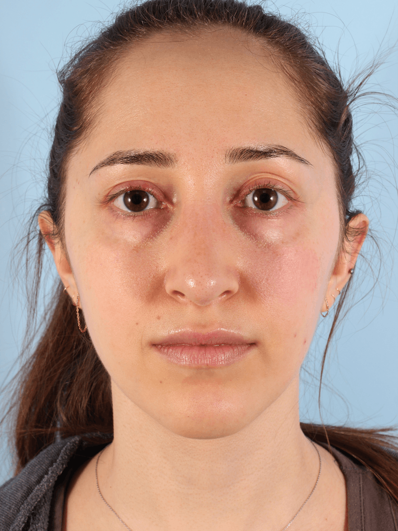 Rhinoplasty Before & After Gallery - Patient 260727 - Image 4