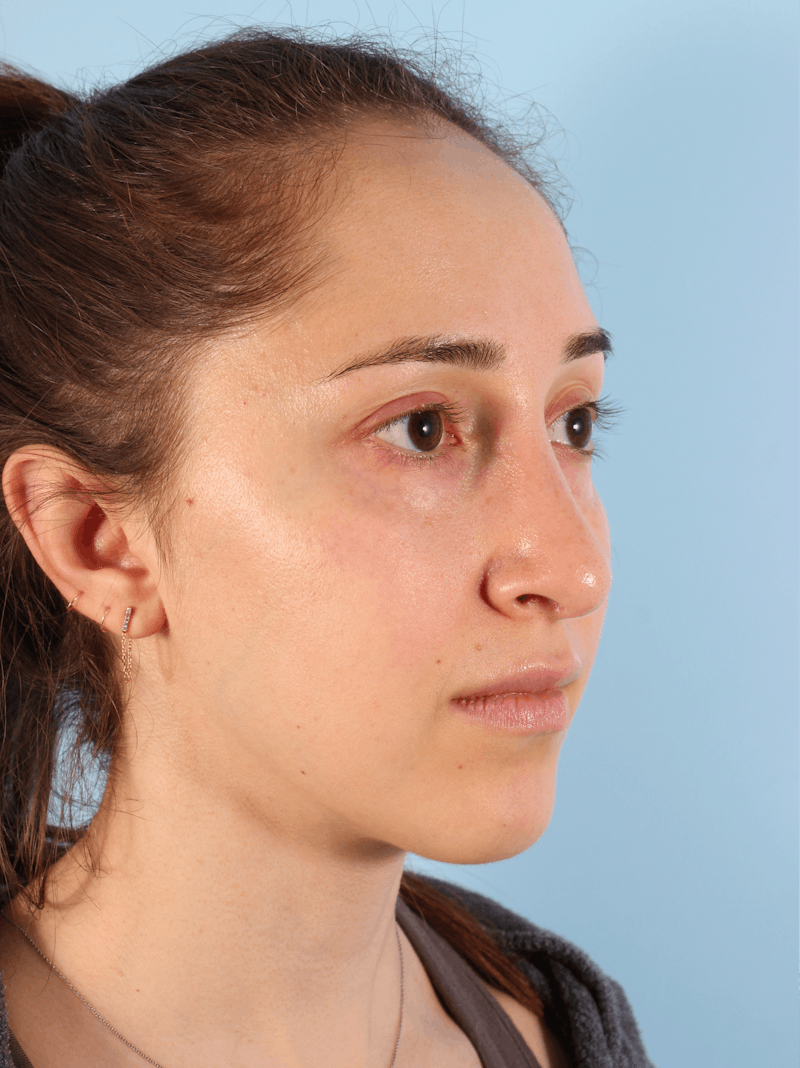 Rhinoplasty Before & After Gallery - Patient 260727 - Image 9