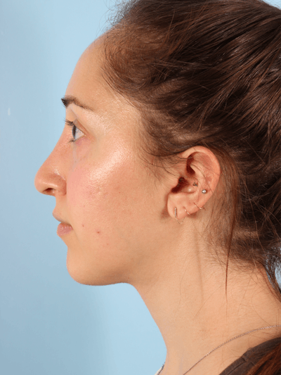 Rhinoplasty Before & After Gallery - Patient 260727 - Image 2