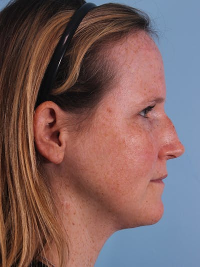 Rhinoplasty Before & After Gallery - Patient 230162 - Image 1
