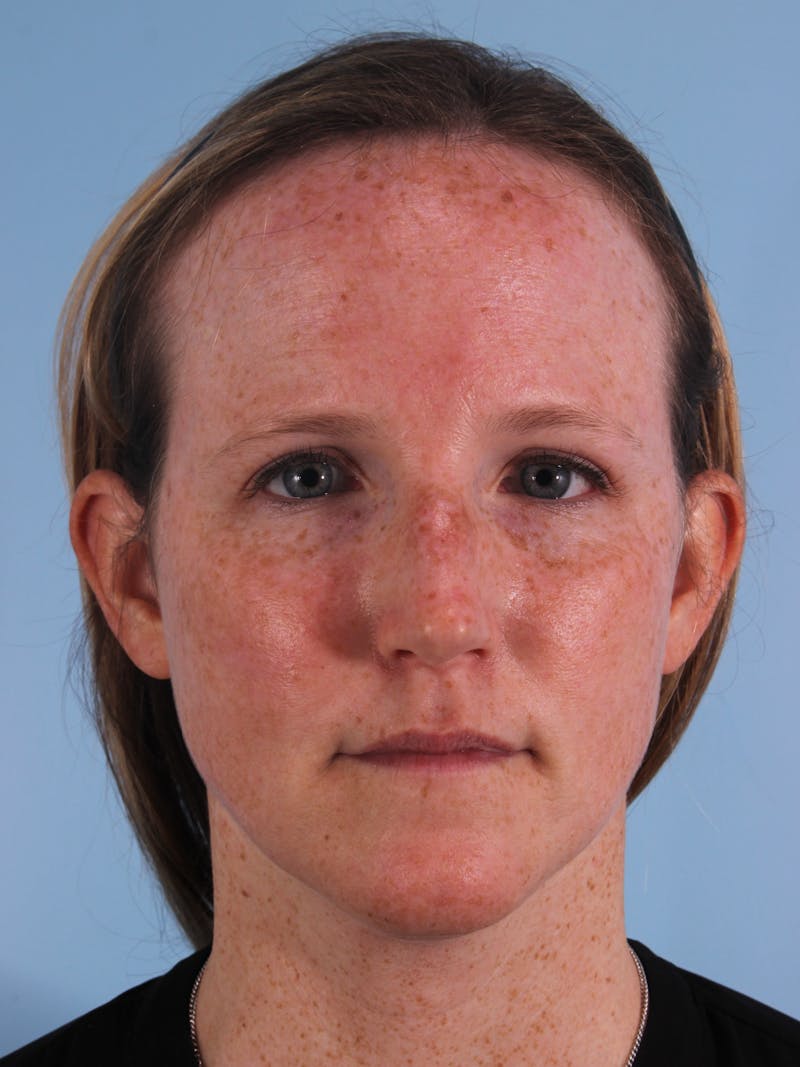Rhinoplasty Before & After Gallery - Patient 230162 - Image 3