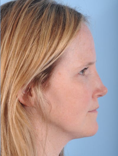 Rhinoplasty Before & After Gallery - Patient 230162 - Image 2