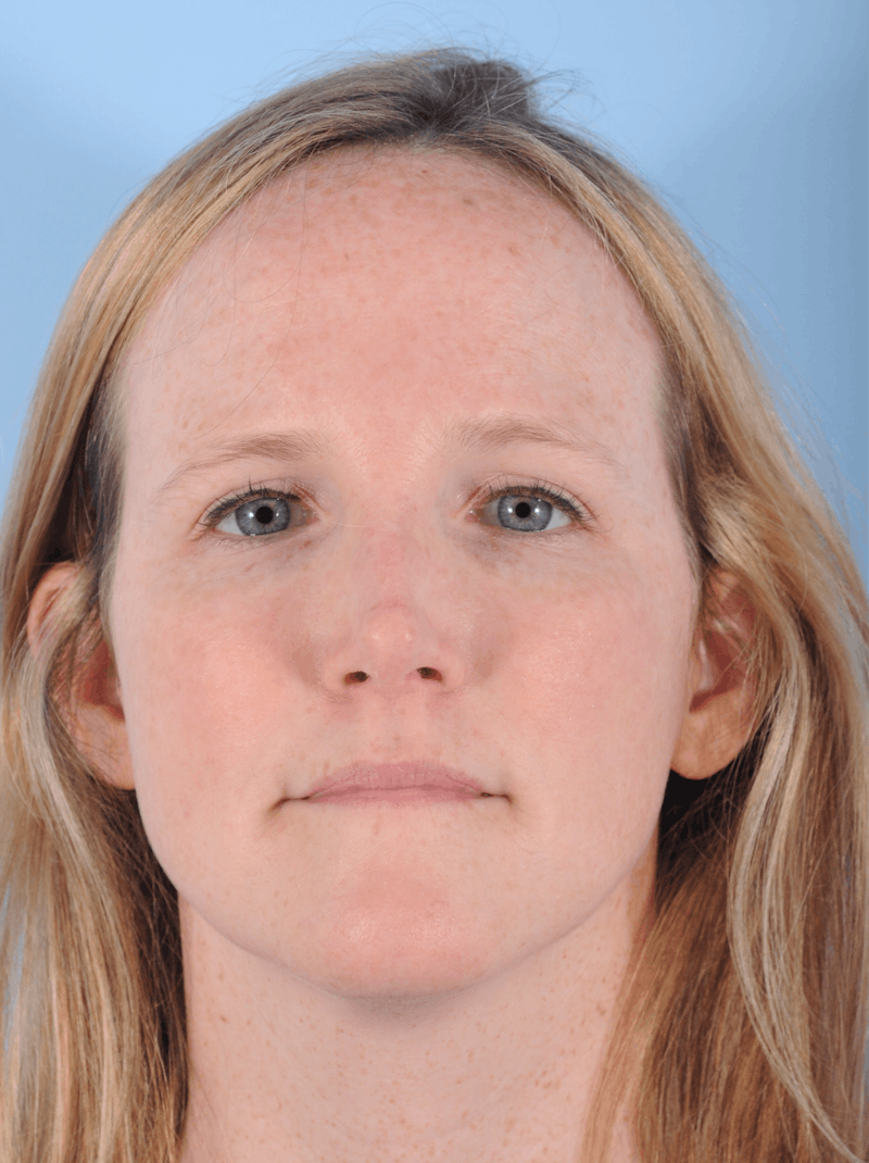 Rhinoplasty Before & After Gallery - Patient 230162 - Image 4