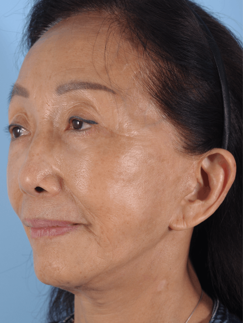 Upper Blepharoplasty Before & After Gallery - Patient 137842 - Image 6
