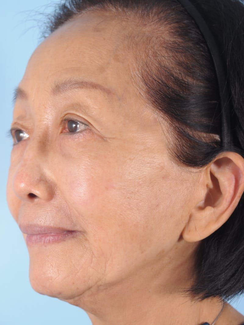 Upper Blepharoplasty Before & After Gallery - Patient 137842 - Image 5