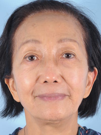 Upper Blepharoplasty Before & After Gallery - Patient 137842 - Image 1