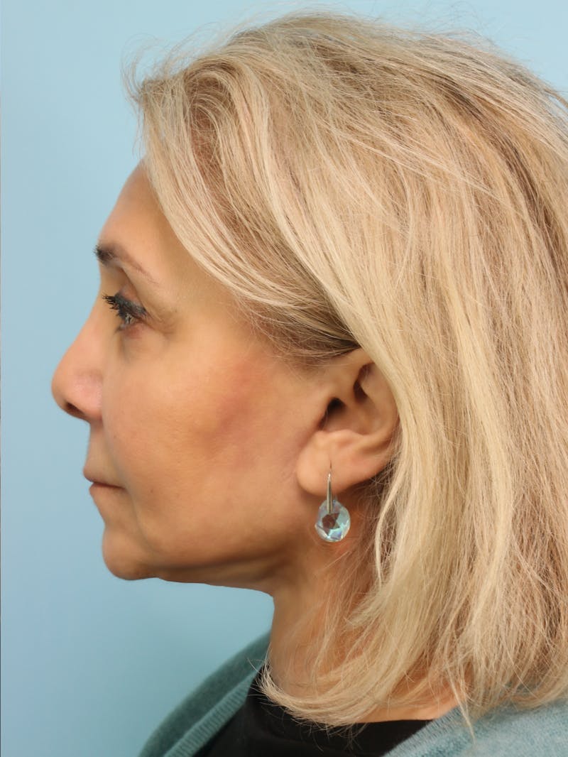 Facelift Before & After Gallery - Patient 300086 - Image 8