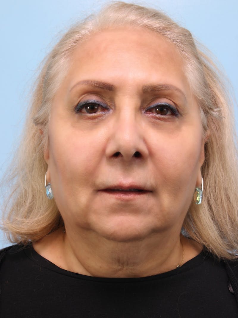 Facelift Before & After Gallery - Patient 300086 - Image 1