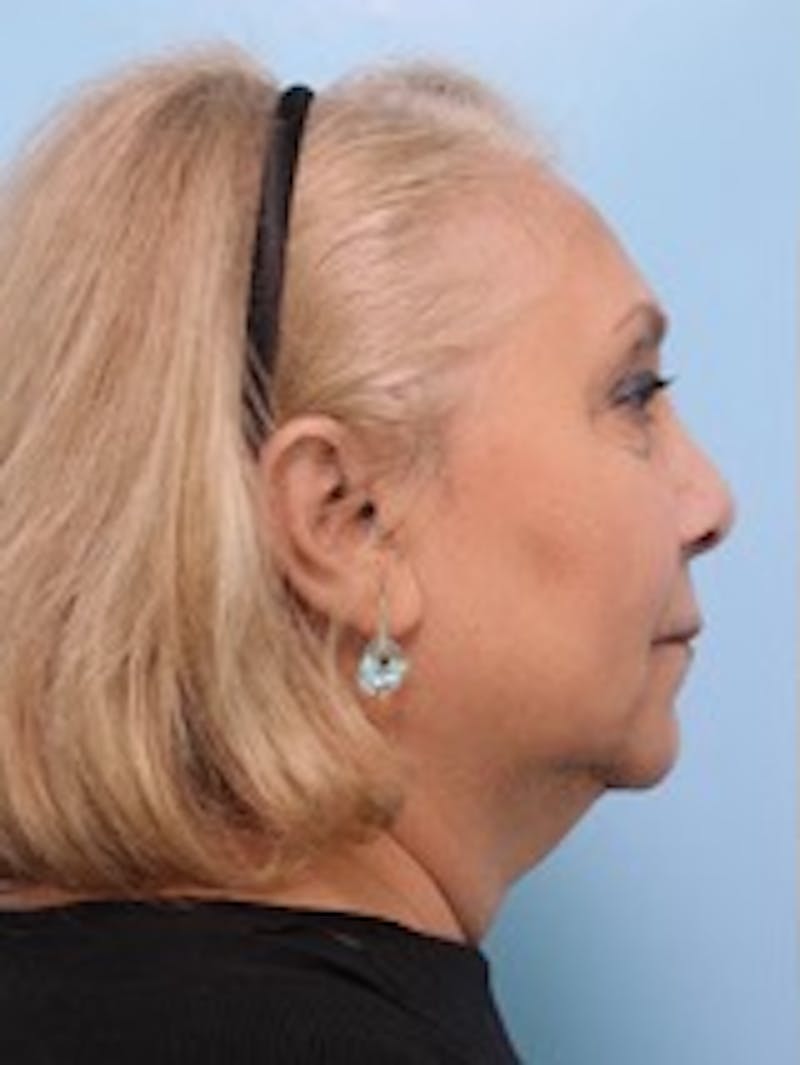 Facelift Before & After Gallery - Patient 300086 - Image 5