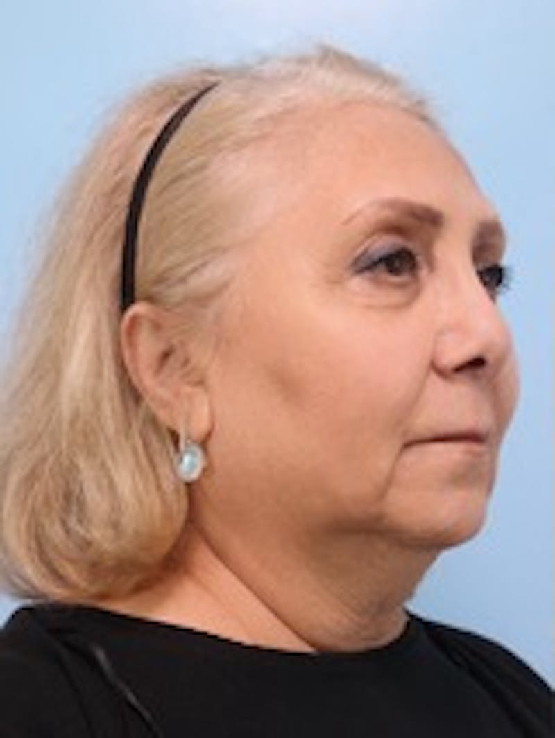 Neck Lift Before & After Gallery - Patient 308360 - Image 1