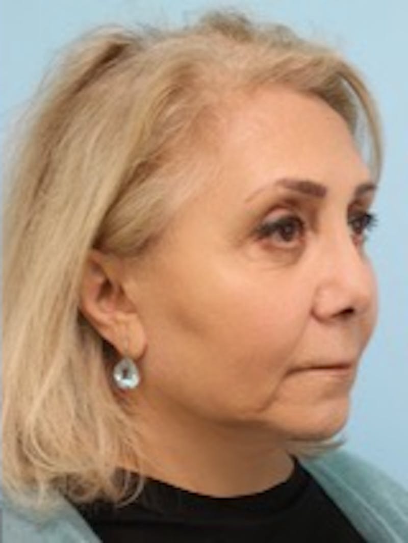 Facelift Before & After Gallery - Patient 300086 - Image 4