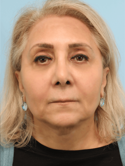 Facelift Surgery  Before & After Gallery - Patient 300086 - Image 2