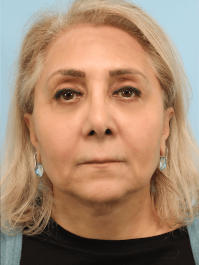 Facelift Before & After Gallery - Patient 300086 - Image 2