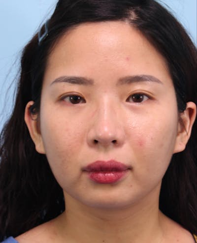 Scarlet RF Microneedling Before & After Gallery - Patient 234090 - Image 1