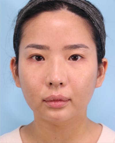 Scarlet RF Microneedling Before & After Gallery - Patient 234090 - Image 2