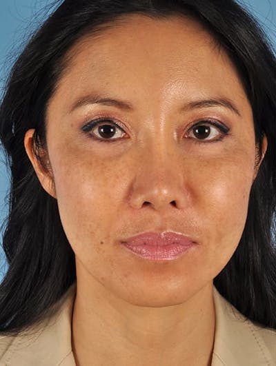 IPL Photofacial Before & After Gallery - Patient 140742 - Image 1