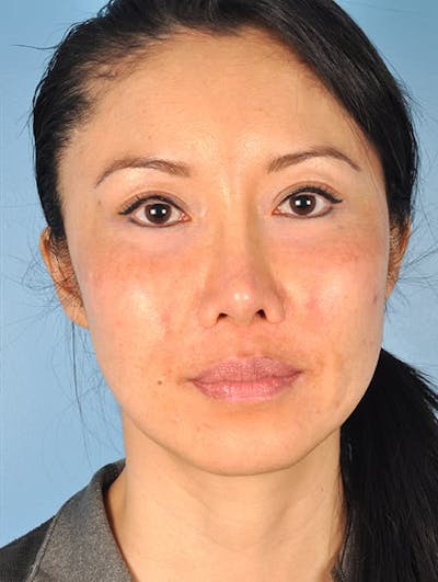 IPL Photofacial Before & After Gallery - Patient 140742 - Image 2