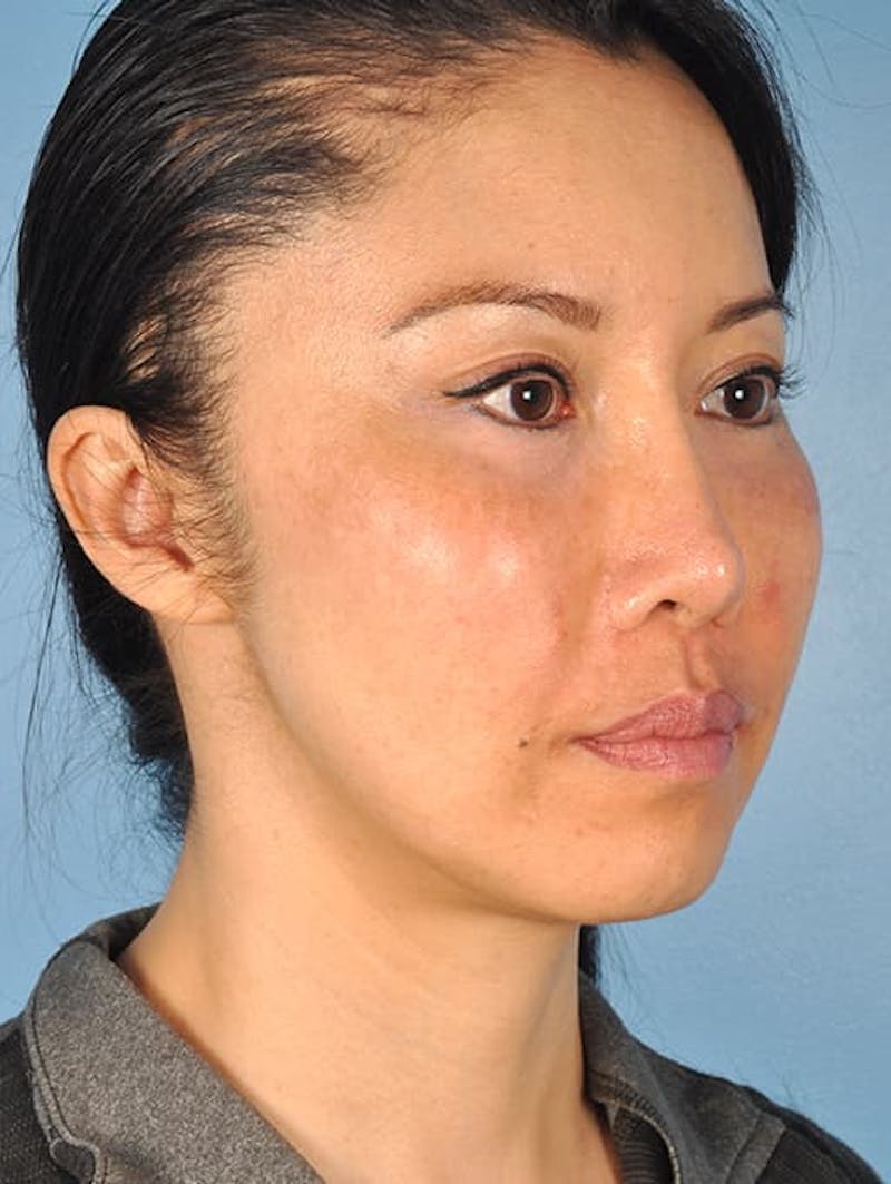 Facial Resurfacing Before & After Gallery - Patient 399676 - Image 4