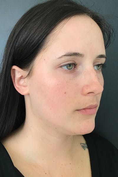 IPL Photofacial Before & After Gallery - Patient 297323 - Image 1