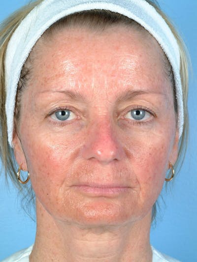 IPL Photofacial Before & After Gallery - Patient 299537 - Image 1
