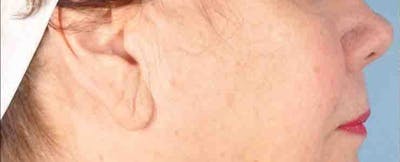 Earlobe Repair Before & After Gallery - Patient 149257 - Image 1