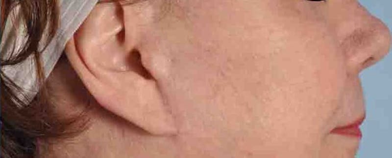 Earlobe Repair Before & After Gallery - Patient 149257 - Image 2