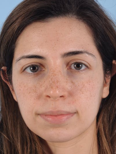 IPL Photofacial Before & After Gallery - Patient 103726 - Image 1