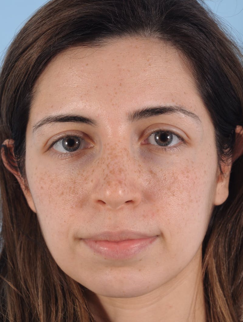 IPL Photofacial Before & After Gallery - Patient 103726 - Image 1
